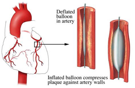 Coronary Angioplasty - Interventional Cardiovascular Procedures - Cardiovascular Health Services ...