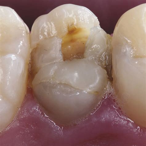 The Old Composite Resin Restoration Was Dislodged During The Clinical