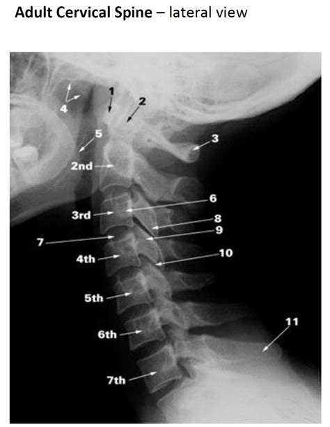 Adult Cervical Spine Lateral View Diagram Quizlet