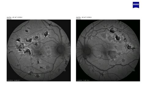 Acute Posterior Multifocal Pigment Epitheliopathy Retina Image Bank