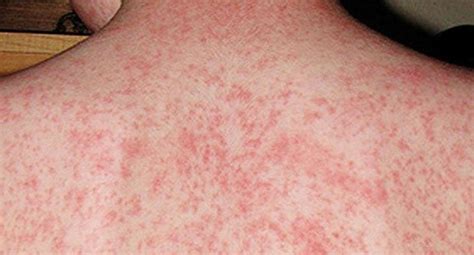 Measles Warning Two Babies Catch Disease In Sydney