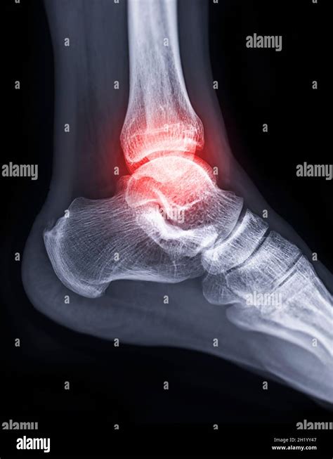 X Ray Image Of Ankle Joint Showing Fracture Of Ankle Joint Stock Photo