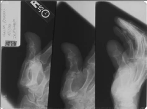 Plain X Ray Showing Loss Of Bone In The Distal Thumb Download