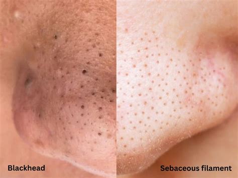 Claudia Christin On Twitter Why Your Blackheads Are Not Going Away