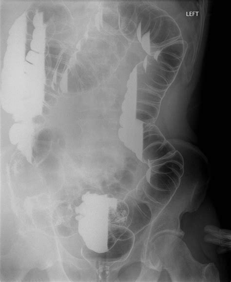 Diverticular Stricture Image