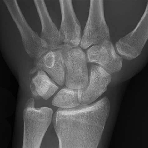 Posteroanterior Plain Radiograph Of Left Wrist Approximately 1 Year