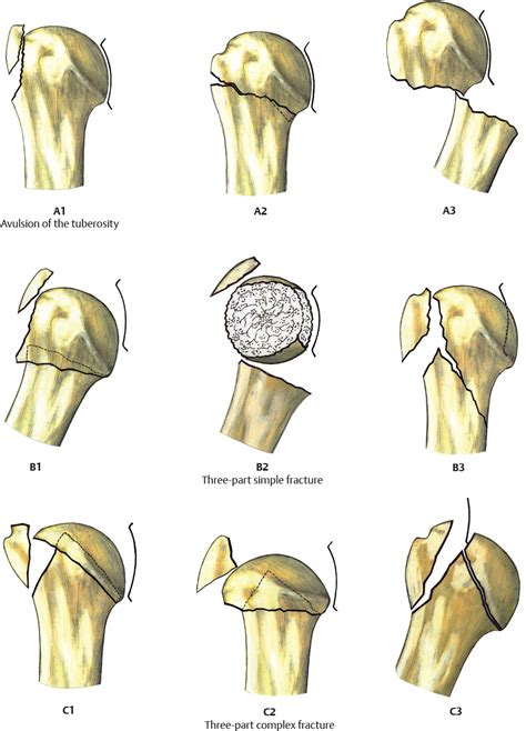 Proximal Humerus Fracture Classification