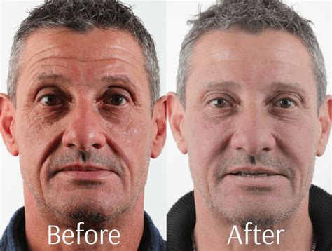 Botox For Men In Surrey By Dr Yasmin Albeyatti Face And Fillers