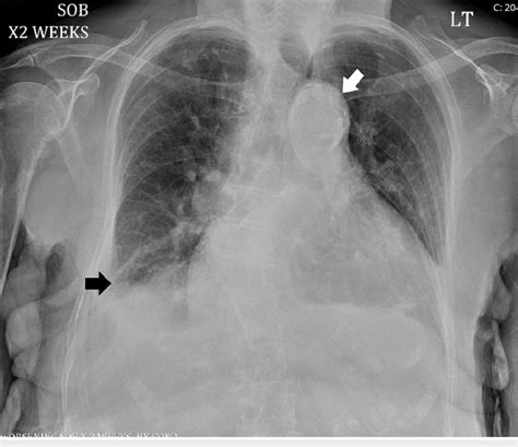 Chest Radiograph Showing A Prominent And Calcified Aortic Knob White