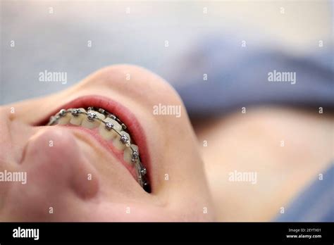 Smiling Young Woman With Brackets On Teeth Close Up Metal Self Ligating Dental Braces Stock