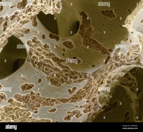Osteoporosis Coloured Scanning Electron Micrograph Sem Of An
