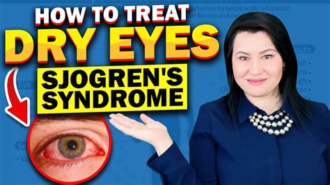 Dry Eyes Sjogrens Syndrome Treatment Tips Youtube