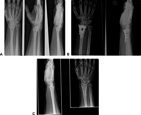 Orthogonal Plate Fixation With Corrective Osteotomy For Treatment Of