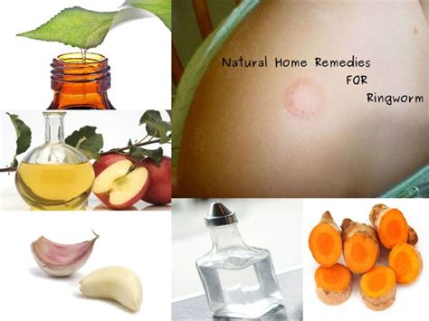 Natural Home Remedies For Ringworm Ringworm Is A Known Fungal