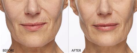 But with so many different types out there it can be hard to decide which is the best lip filler out there for you and your individual goals. Restylane in Jacksonville - Dermal Filler Specialists at ...