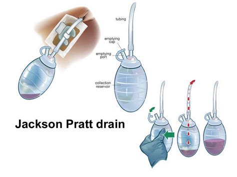 Jackson Pratt Drain Uses Care Jackson Pratt Clogged And Complications