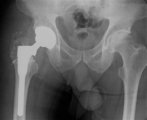 Total Hip Arthroplasty Infection Caused By An Unusual Organism