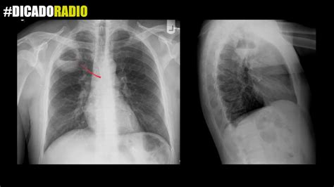 Abscesso Pulmonar Raio X