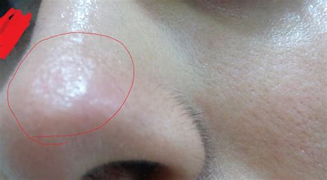 Tca Peel On Nose Scars Scar Treatments