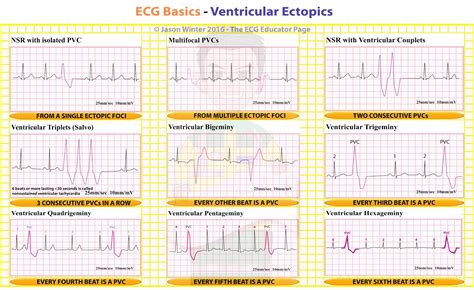 The 12 Lead Ecg Of Ventricular Arrhythmias Originating From The Images
