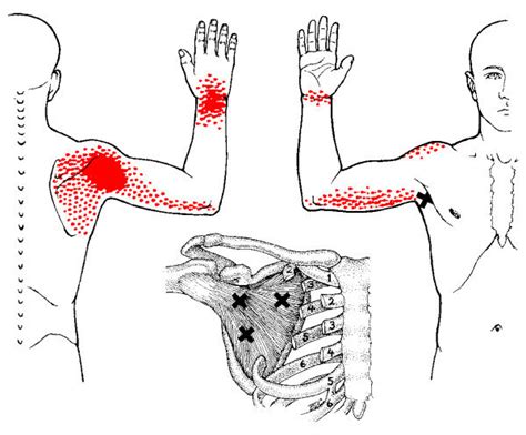Do you have pain between your shoulder blades? Referred pain pattern from subscapularis muscle MTrP. The ...