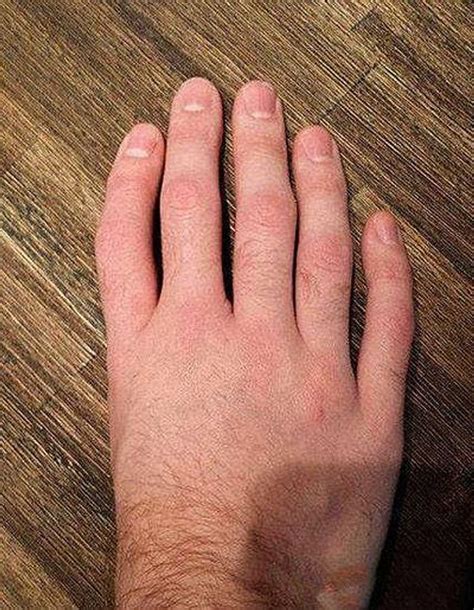 People Are Sharing Photos Of Their Unusual Body Parts And The Internet