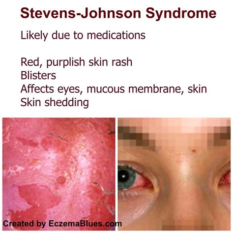 Life Threatening Skin Rash Series Stevens Johnson Syndrome Eczema Blues