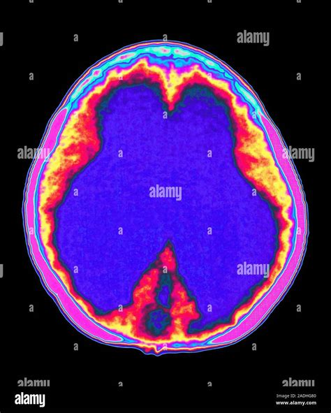 Hydrocephalus Coloured Computed Tomography Ct Scan Of An Axial