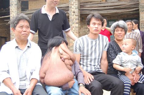 Huang Chuncai The Man Who Has The World S Biggest Facial Tumour Mirror Online