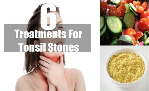 10 Best Images About Tonsil Stones Remedy On Pinterest Posts Tonsil