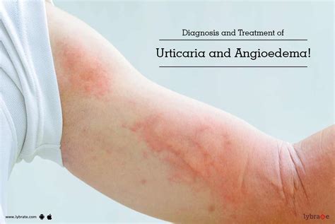 Diagnosis And Treatment Of Urticaria And Angioedema By Dr Molly