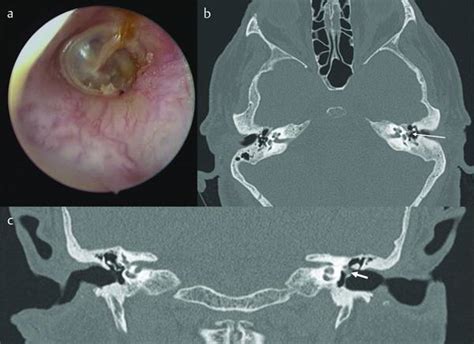 Radiological Considerations For Endoscopic Middle Ear Surgery Ento Key