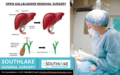 Gallbladder Removal Open Causes Symptoms Treatment Sexiz Pix