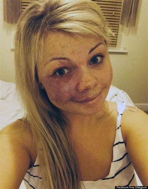 Young Woman Shows Facial Birthmark In No Make Up Selfie The Internet
