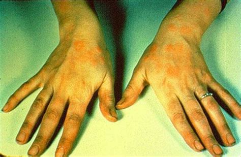 Image Nummular Dermatitis Hands Msd Manual Professional Edition