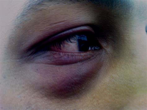Black Eye Possible Causes Signs Symptoms And Home Remedies