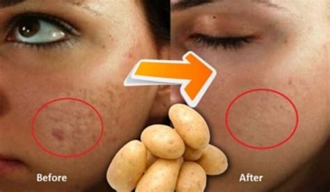 How To Remove Dark Spots On Face With 10 Home Remedies Right Home