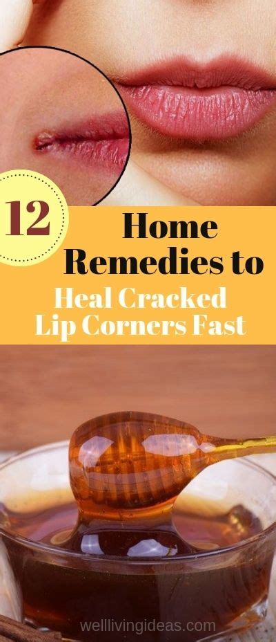 How To Heal Cracked Lip Corners Fast And Naturally Best Home Remedies