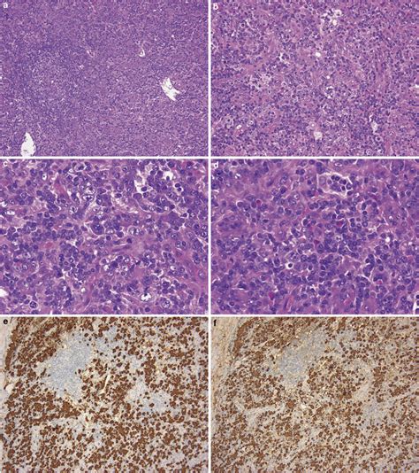 Histopathology Of Systemic Igg4 Related Lymphadenopathy Download