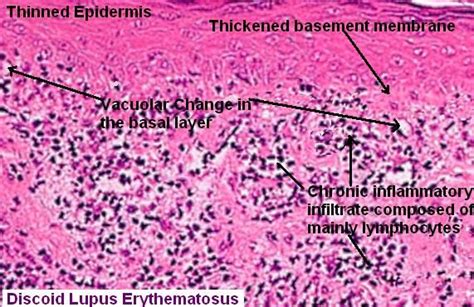 Pin By Dr Sampurna Roy On Histopathology Discoid Lupus Discoid Lupus