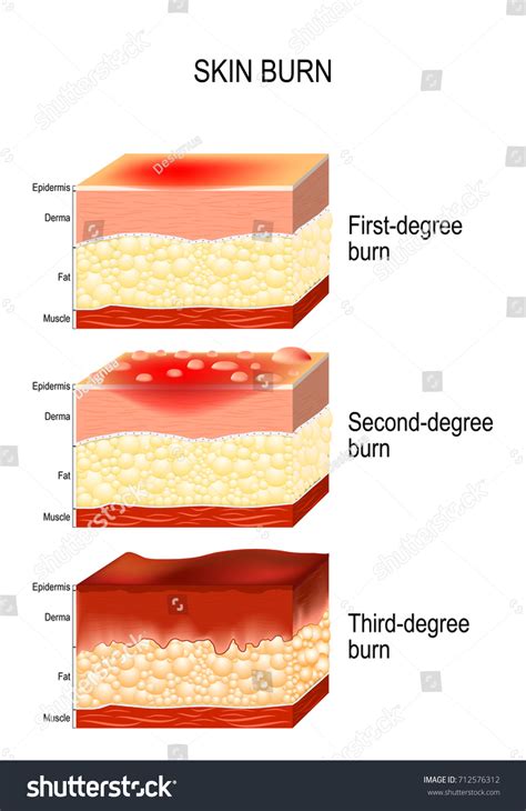 Skin Burn Three Degrees Burns Type Stock Vector Royalty Free