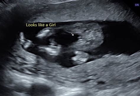 Can Ultrasound Be Wrong About Gender Mozswift