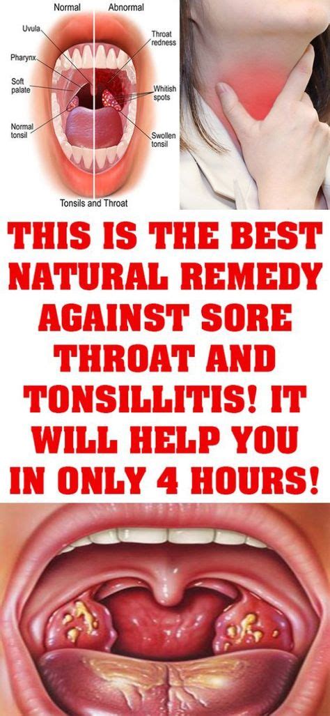 This Is The Best Natural Remedy Against Sore Throat And Tonsillitis It