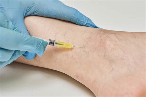Sclerotherapy For Varicose And Spider Vein Treatment Flickr