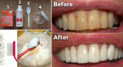 the importance of removing plaque from your teeth t tapp