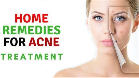 Pimple Treatment Top 10 Methods How To Remove Acne And Skin Care