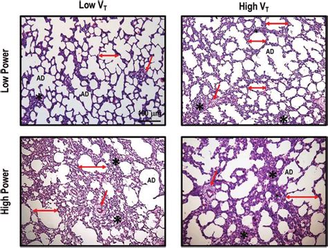 You may have one nodule on the lung or several nodules. Representative photomicrographs (light microscopy) of lung ...