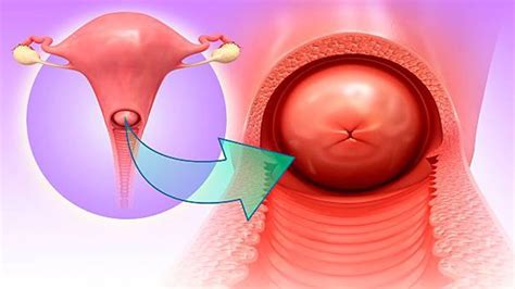 El cáncer de útero puede desarrollarse a partir de cambios en las células del endometrio. ¿Qué es la cervicitis? - Que es - WebMediums