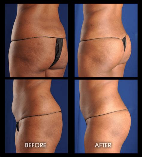 Buttock Augmentation With Liposuction Pictures Fat