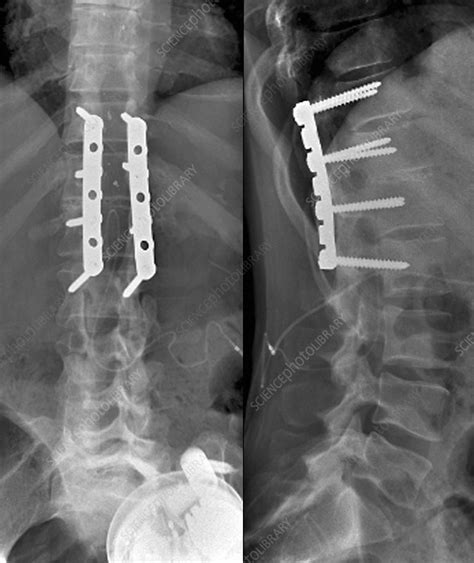 Spinal Stenosis After Surgery X Ray Stock Image C0269856